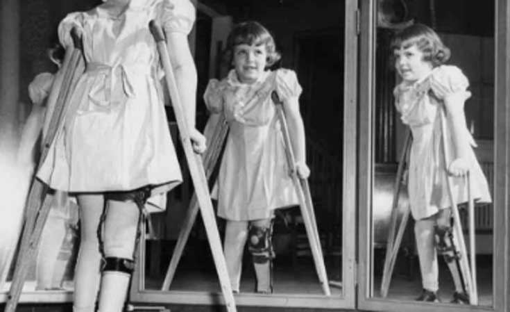 niña con polio en los 50s