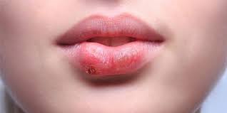 el herpes es un invitado indeseable que se puede contagiar con solamente un beso.